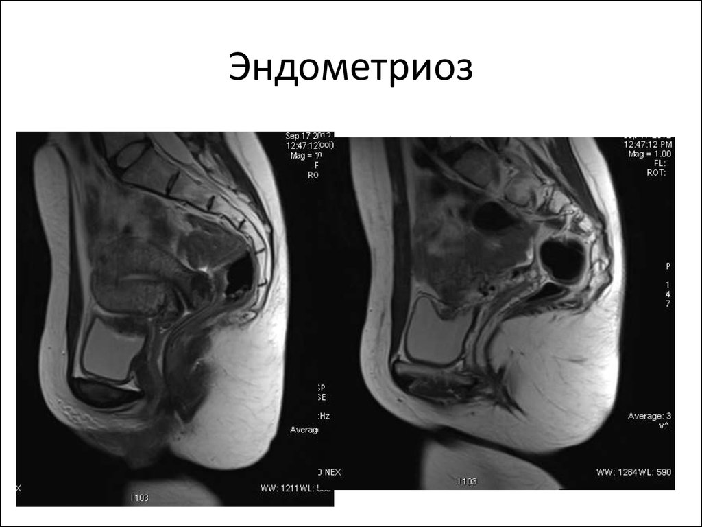 Эндометриоз на МРТ