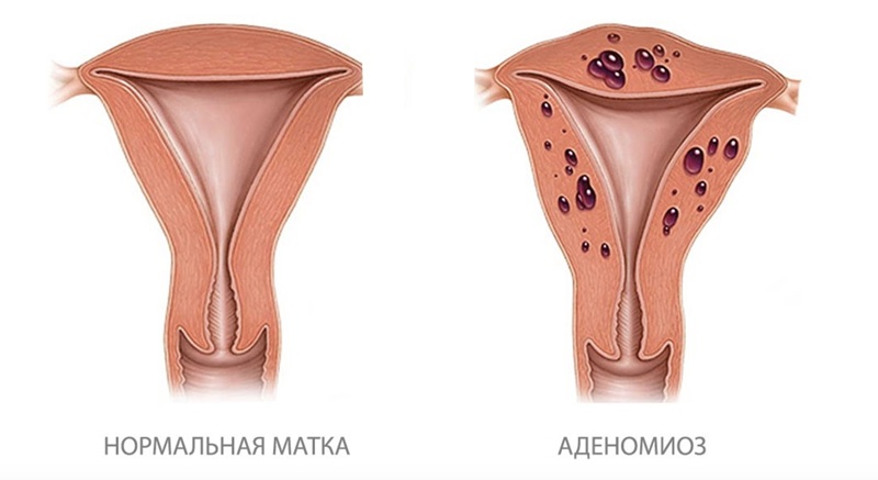 Сравнение здоровой матки и аденомиоза матки.