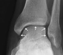 Рентген голеностопного сустава - снимки при деформации