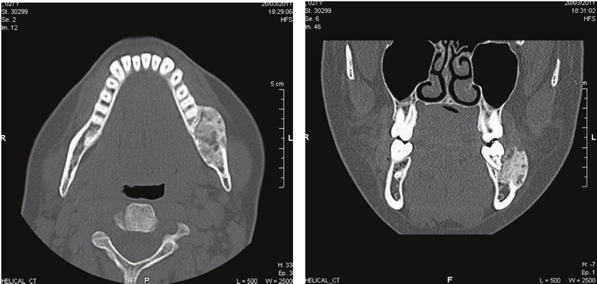 Опухоль кости на КТ челюсти