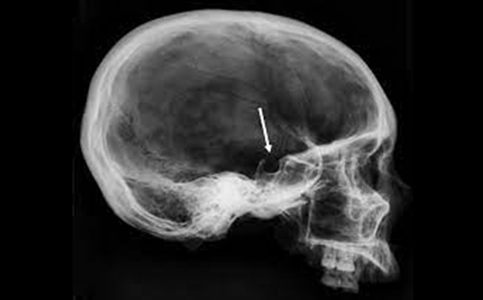 Рентген турецкого седла - диагностика