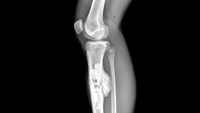 Рентген костей голени при остеосаркоме - снимки