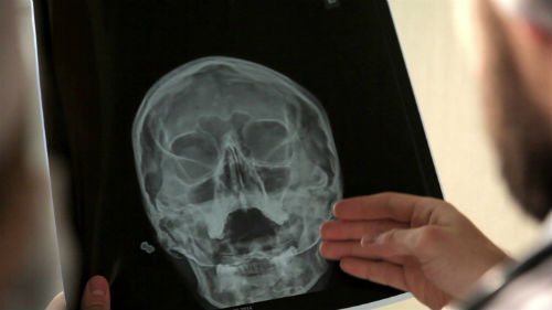 рентгенография воздухоносных пазух носа