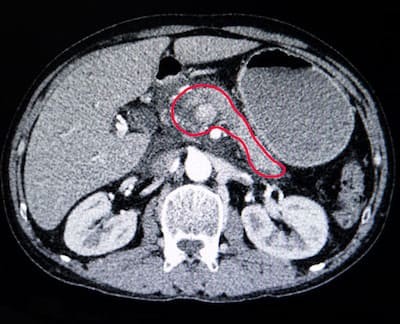 КТ поджелудочной железы - снимки