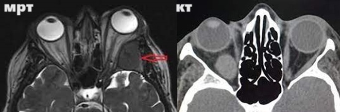 КТ глазных орбит или МРТ - что лучше, сравнение