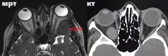 КТ глазных орбит или МРТ - что лучше