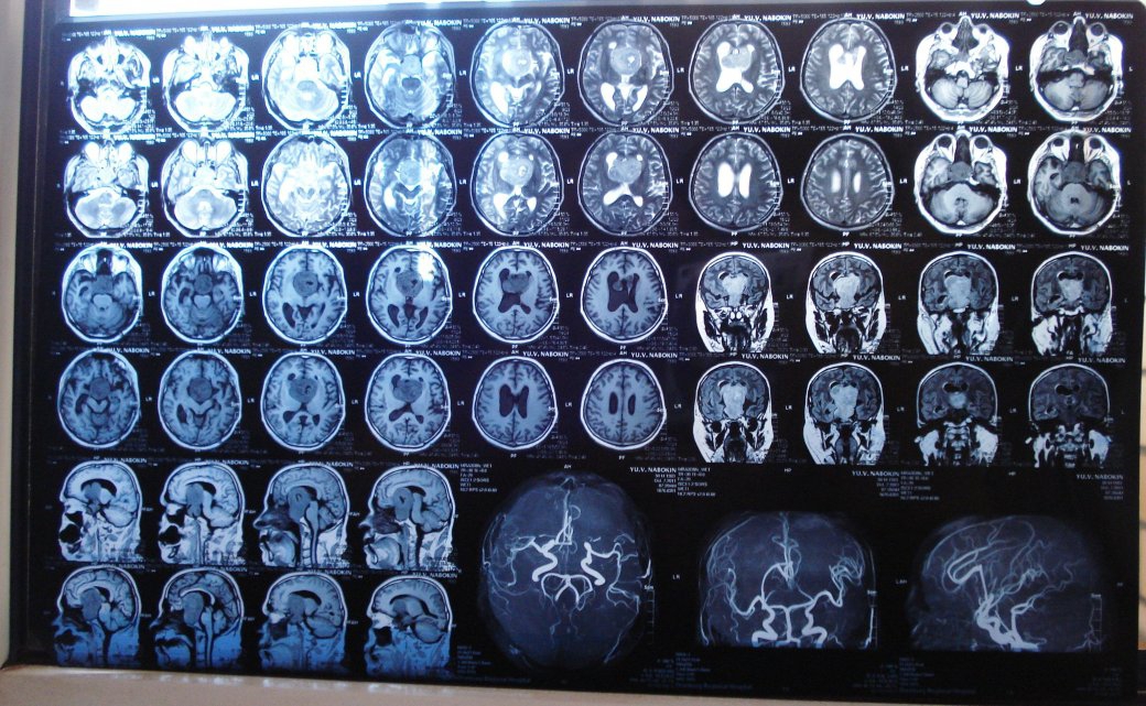 МРТ головного мозга снимки