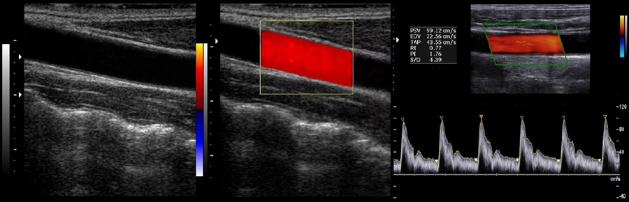 Дуплексное сканирование сосудов - снимки