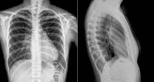 Рентген грудного отдела позвоночника - диагностика