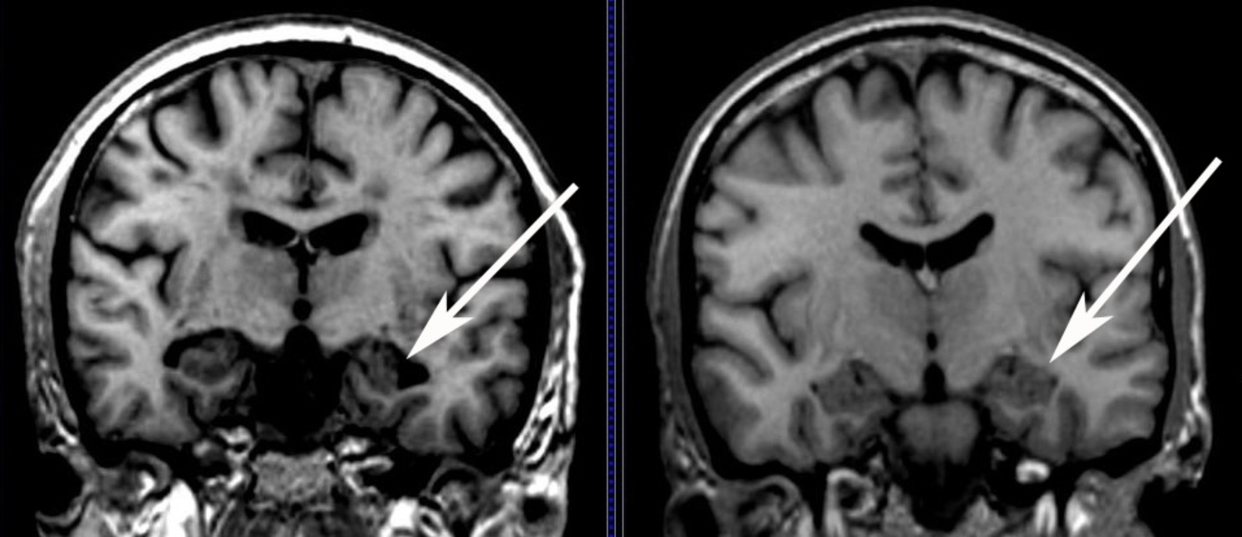 Снимок МРТ при болезни Альцгеймера