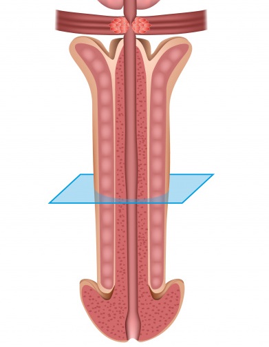Уретрит у мужчин