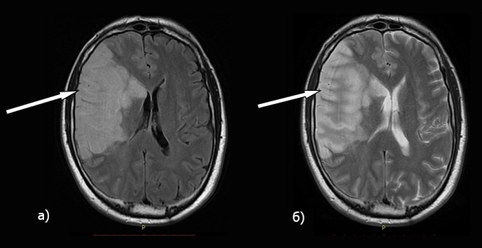 Инсульт на МРТ головного мозга