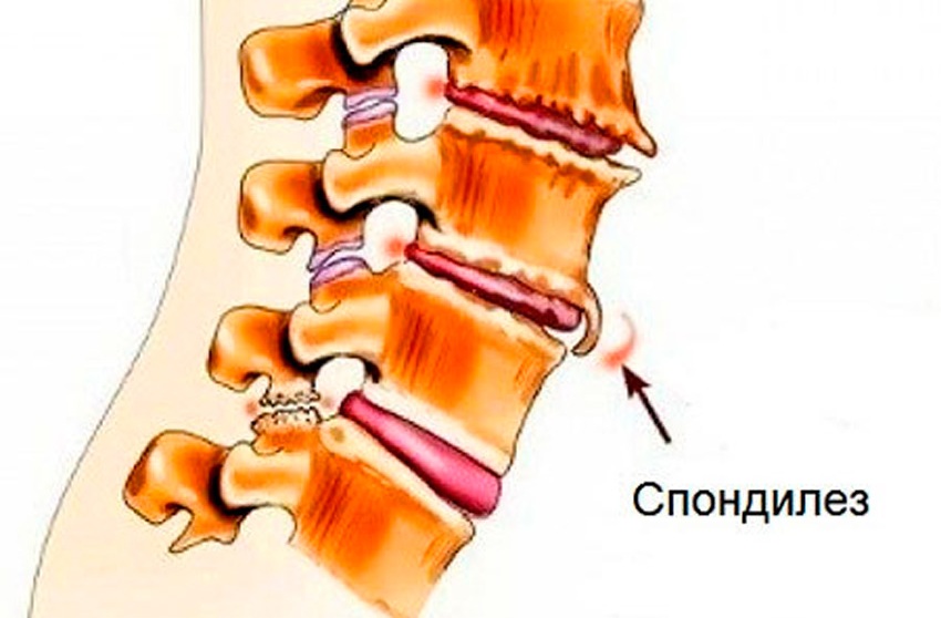 Позвонковый спондилез грудного отдела.