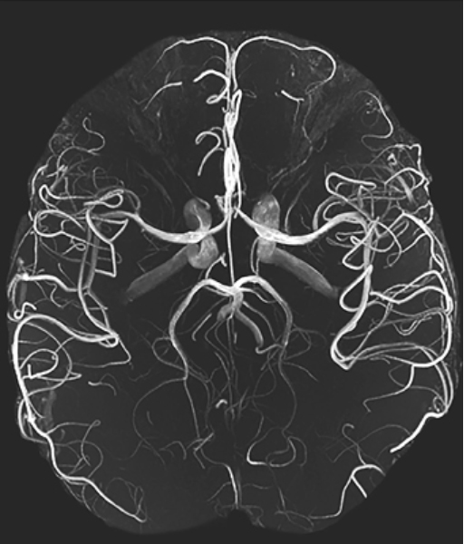 МРТ сосудов головного мозга на снимке