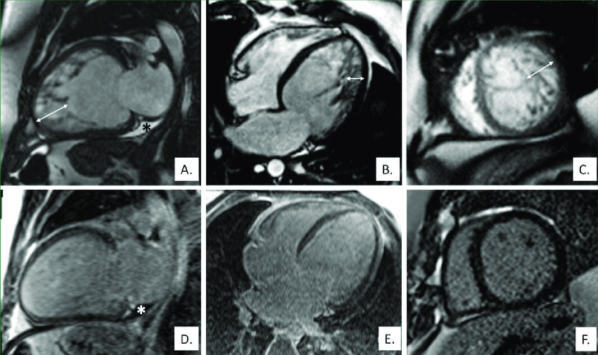 Снимки МРТ сердца