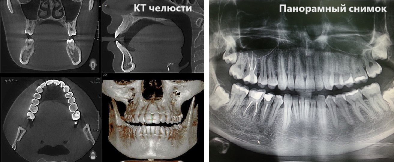 Сравнение КТ челюсти и панорамного снимка