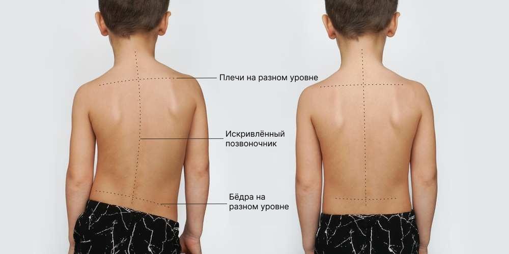 Искривление позвоночника.