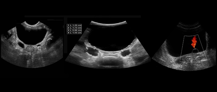 УЗИ почек, мочевого и простаты - снимки.