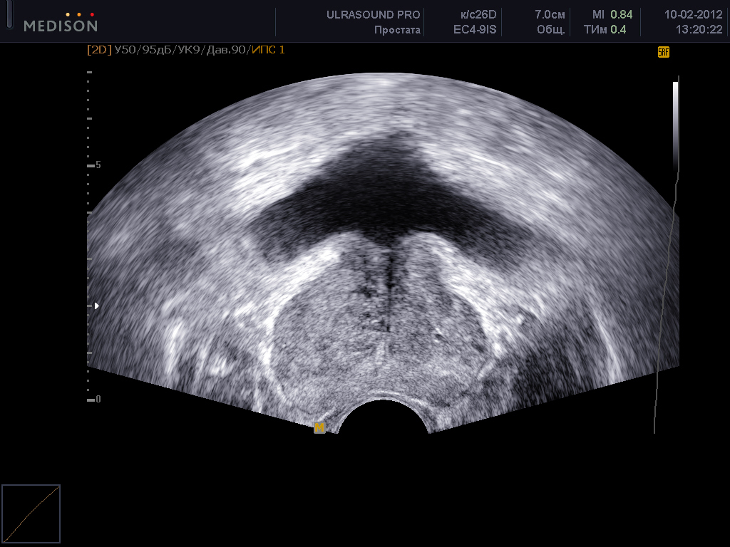 УЗИ предстательной железы