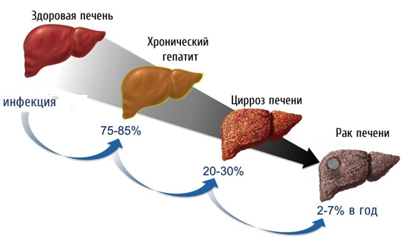 Стадии развития рака печени.