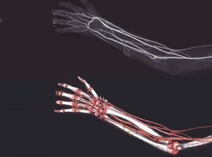 КТ сосудов верхней конечности - снимки