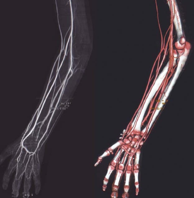 КТ сосудов верхней конечности - снимки