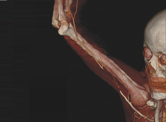 КТ сосудов верхней конечности - что показывает