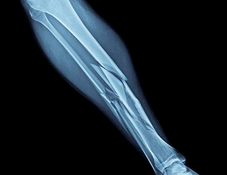 Рентген костей голени при переломе - диагностика