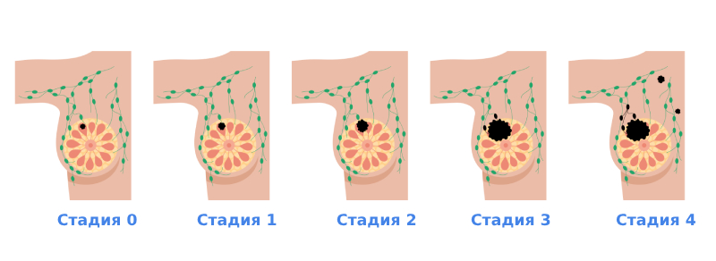 Стадии ракак молочной железы.
