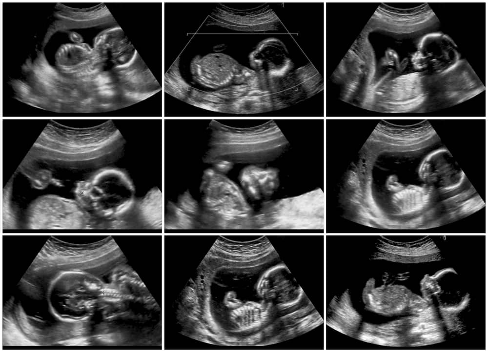 УЗИ при беременности 2 триместр - что показывают снимки