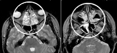 МРТ пазух носа - снимки