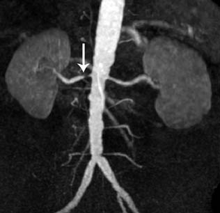 МР-ангиография почечных артерий - снимки