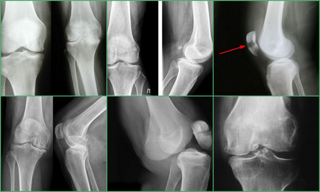 Рентген коленного сустава - что показывают снимки