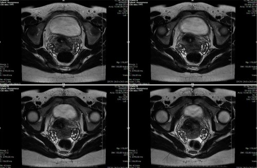 Снимки МРТ органов малого таза