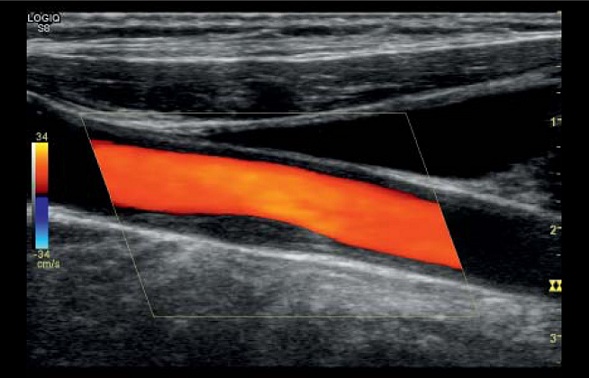 УЗИ сосудов верхних конечностей - снимки