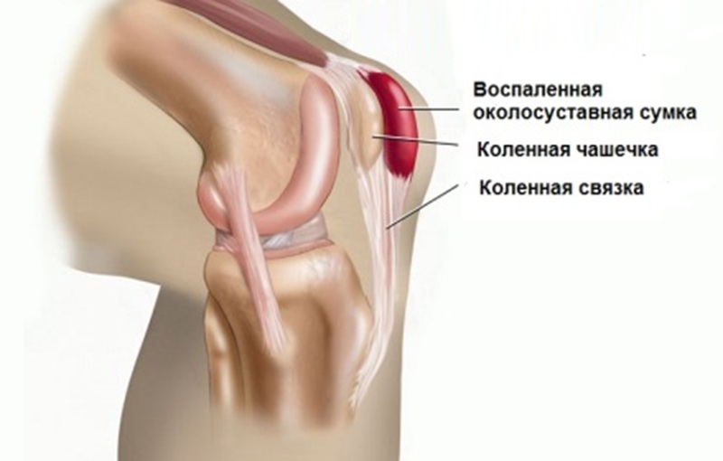 Бурсит коленного сустава - схема.