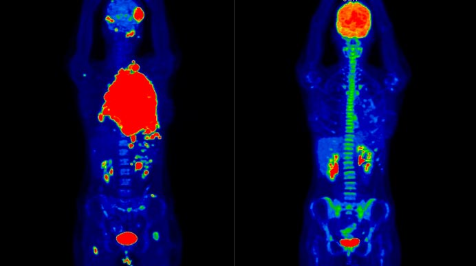 Снимки ПЭТ-КТ всего тела