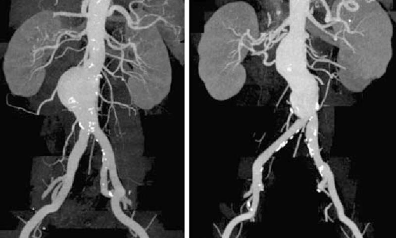 Аневризма аорты на снимках КТ с контрастом