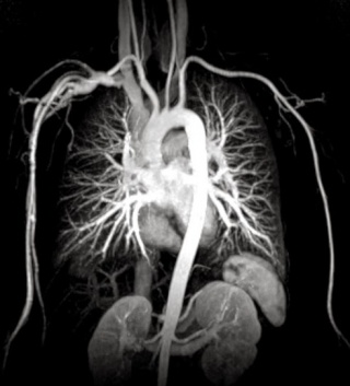 МР-ангиография грудного отдела аорты - снимки