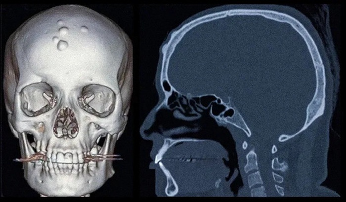 КТ костей лицевого черепа с разных ракурсов и в разных режимах.