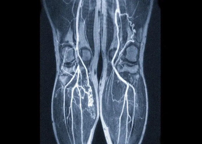 МРТ сосудов ног - снимки.
