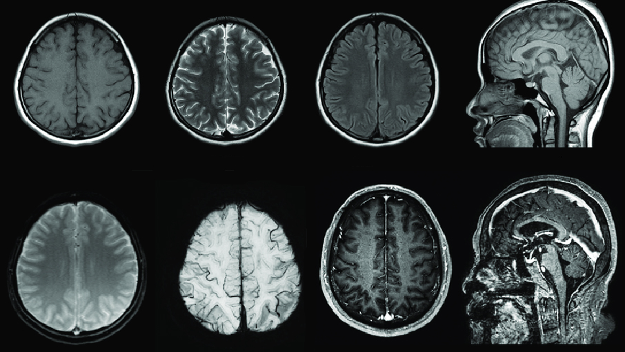 Снимки МРТ головного мозга в разных режимах