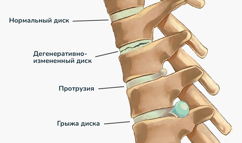 Изменения в межпозвонковом диске от дегенерации до грыжи.