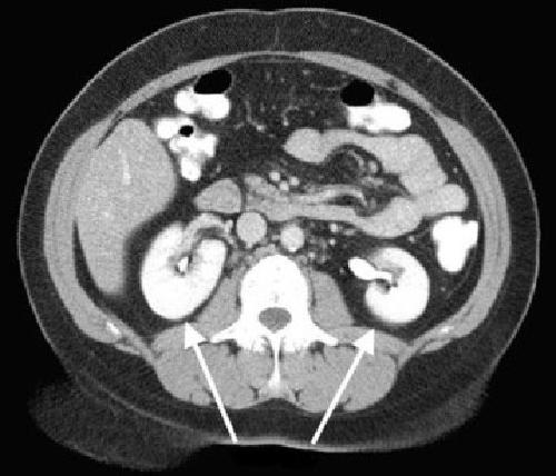 КТ почек и надпочечников - что показывают снимки
