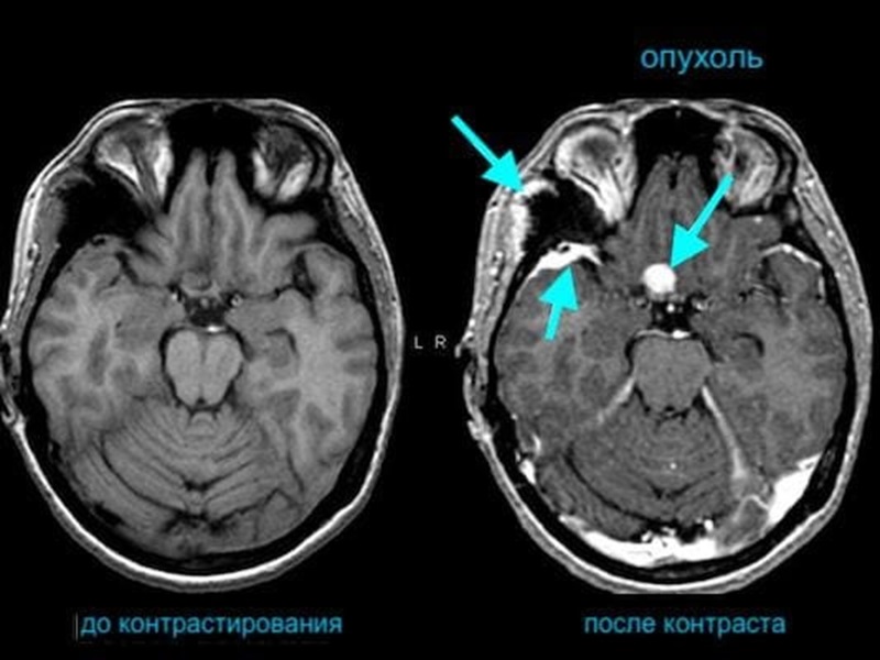 Опухоль мозга на КТ до и после контрастирования