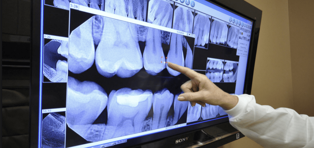 Рентген зуба - что показывают снимки