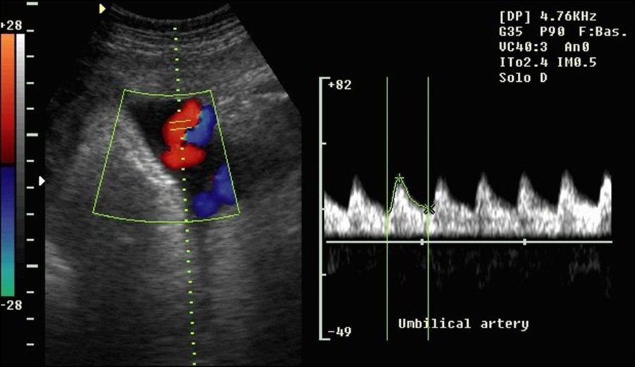 Допплерография сосудов плода - снимок