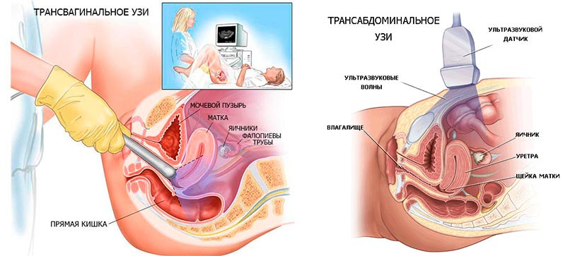 Трансвагинальное и трансабдоминальное УЗИ малого таза.