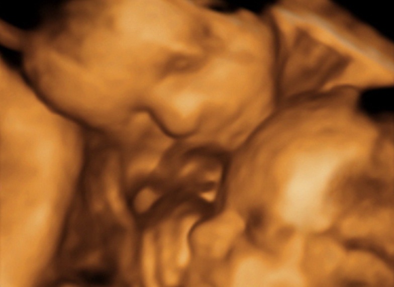 УЗИ многоплодной беременности в 3 триместре - диагностика