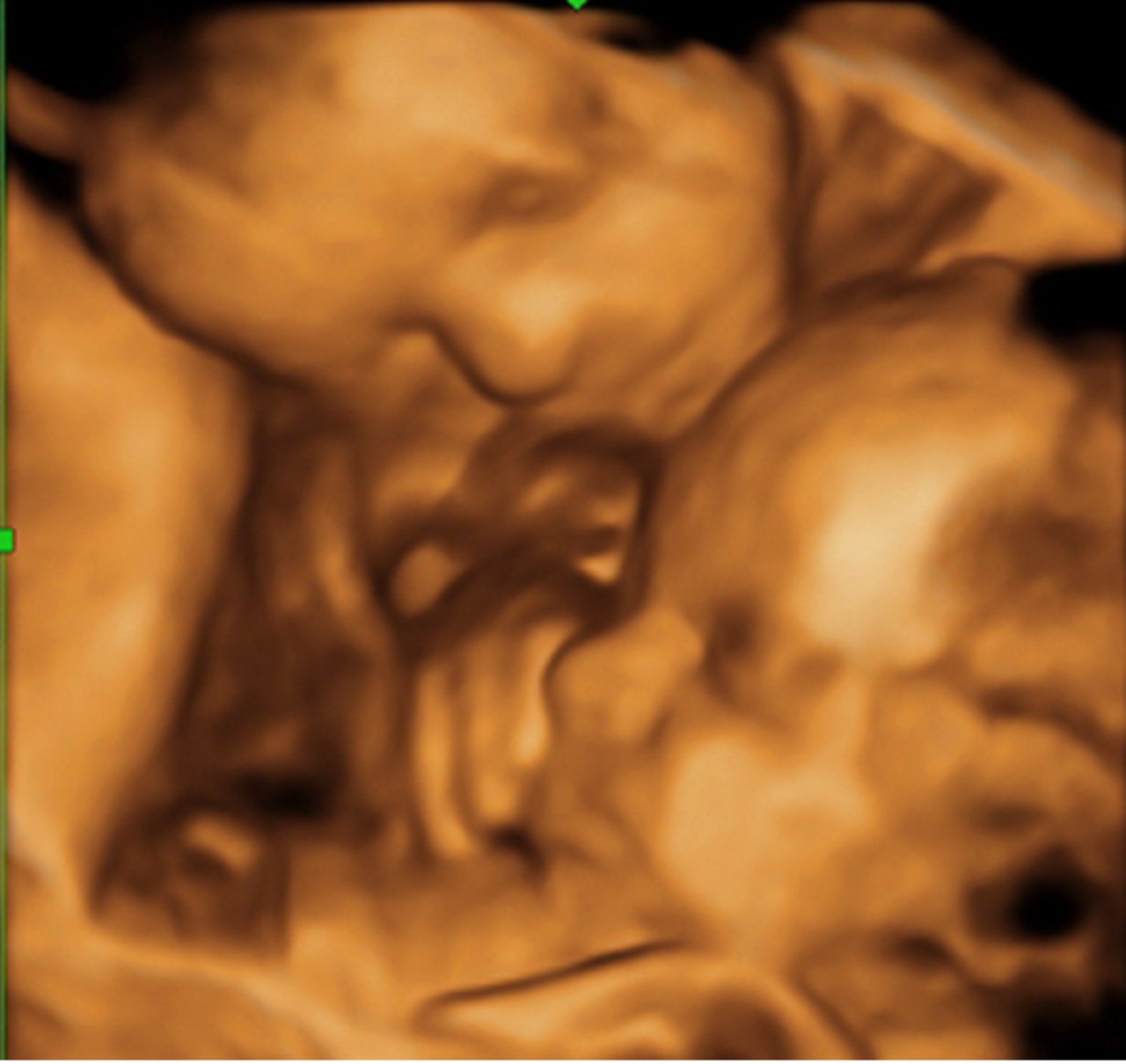 УЗИ многоплодной беременности в 3 триместре - диагностика